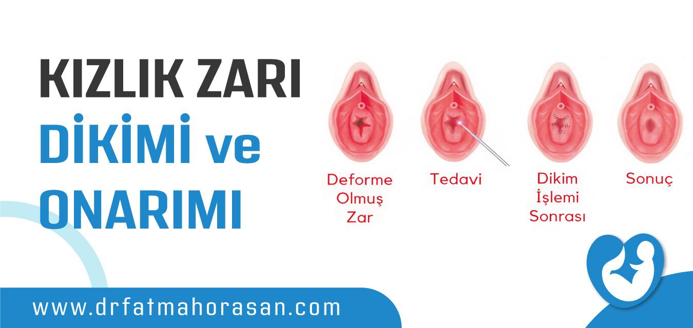 Kızlık Zarı Dikimi ve Onarımı