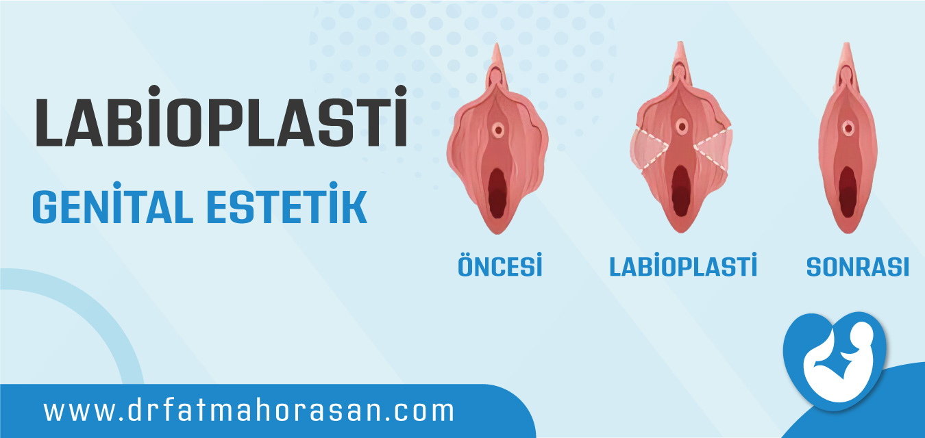 Labioplasti – Genital Estetik